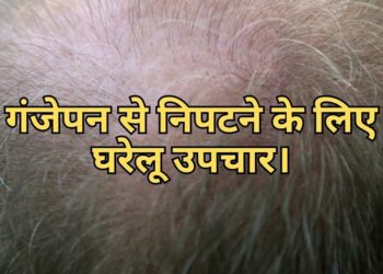 Home remedies to deal with baldness गंजेपन से निपटने के लिए घरेलू उपचार